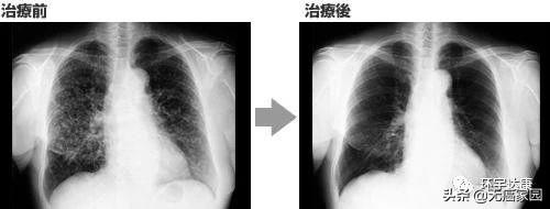 晚期肺癌,NK细胞治疗联合化疗肿瘤消失